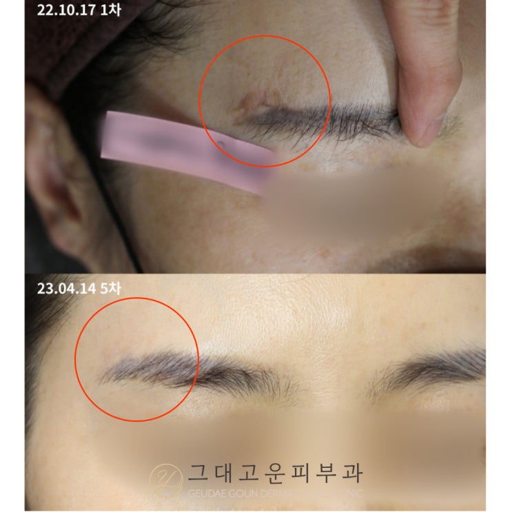 부산 흉터 치료 아무 곳이나 가면 안 되는 이유? 부산 흉터 치료 아무 곳이나 가면 안 되는 이유?