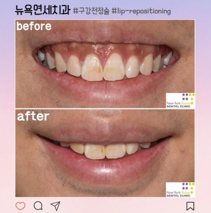  [강남역 거미스마일] 잇몸웃음이 고민이라면? 뉴욕연세치과 구강전정술로 해결!(feat.입술재배치술, lip repositioning)
