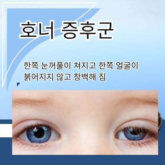  호너증후군 원인 증상 치료