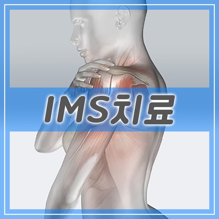  ims 치료, 만성통증과 근육 치료를 위한 물리요법
