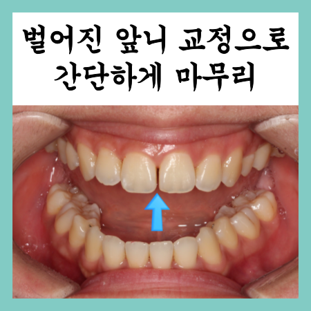  벌어진 앞니 교정으로 간단하게 마무리하기, 상계동교정치과