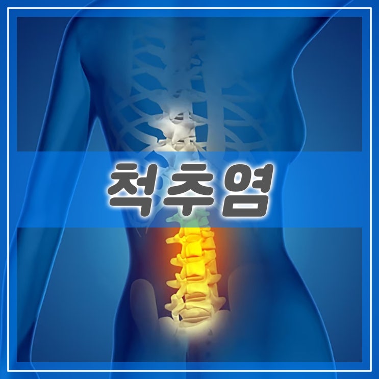  강직성 척추염 원인과 증상 진단 치료 예방법