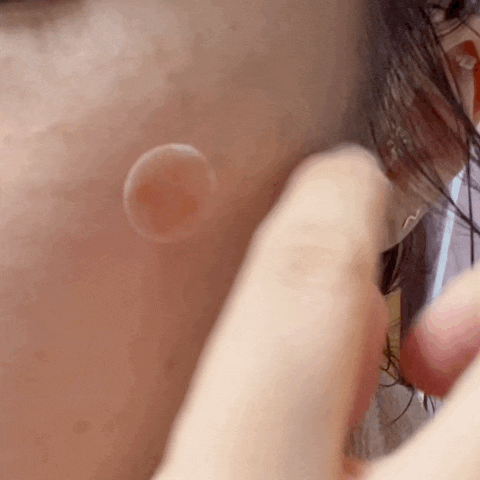  피부 트러블 났을 땐 엘딘 클리어 패치: 마이크로니들패치 후기