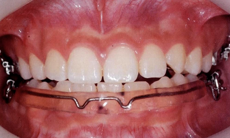  립범퍼 (lip bumper)를 사용한 치아 공간 획득과 교정치료 보조 - 악습관 교정과 근력을 사용한 교정