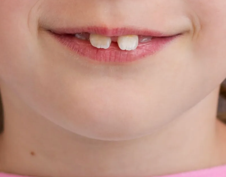  아이가 토끼이빨이 있어요. 앞니 사이가 너무 벌어져 있을 땐? 어린이 정중이개, 앞니 사이 공간