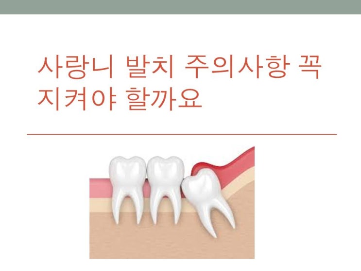  산성역 치과 사랑니 발치 후 주의사항 꼭 지켜야 할까요?