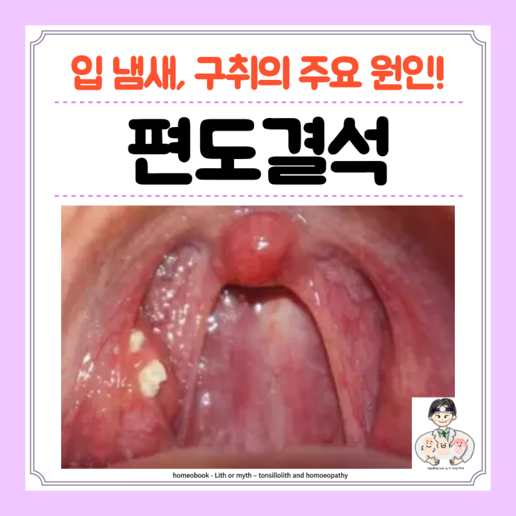  편도결석 원인 증상 제거 빼는법 수술 예방