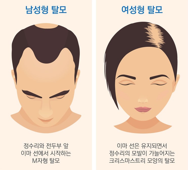  남성형 탈모 관리법: 초기 진단과 맞춤 치료로 탈모 예방하기