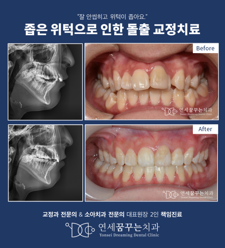 위턱이 좁고 차아가 돌출됐어요! MARPE의 치료 효과 및 치료 과정