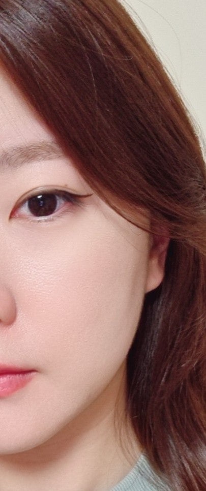  안면홍조레이저 6개월 뒤 솔직후기 옐로우레이저