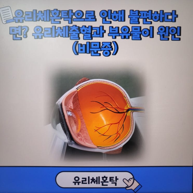  유리체혼탁으로 인해 불편하다면? 유리체출혈과 부유물이 원인(비문증)