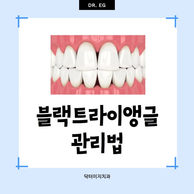 치아의 사각지대 블랙 트라이앵글, 라미네이트로 해결이 가능한 학동역치과
