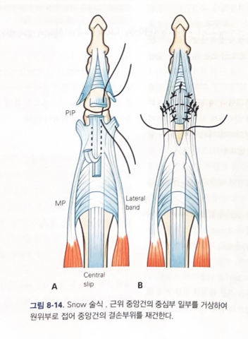[정형외과 전문의] 신전건 파열, Extensor tendon injury (수부외과) : 네이버 블로그