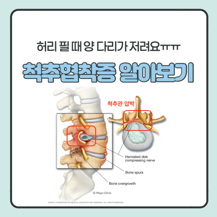  허리 척추관 협착증 접근해 보자