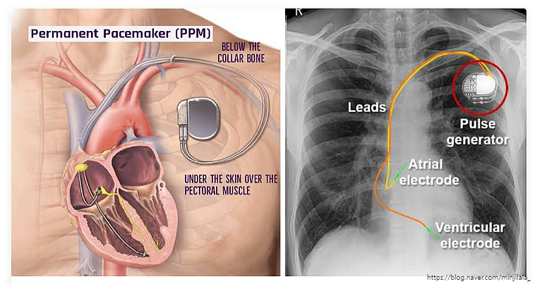 동기능부전증후군 SSS sick sinus syndrome SA block SA arrest 정의 심전도 검사 치료 ...