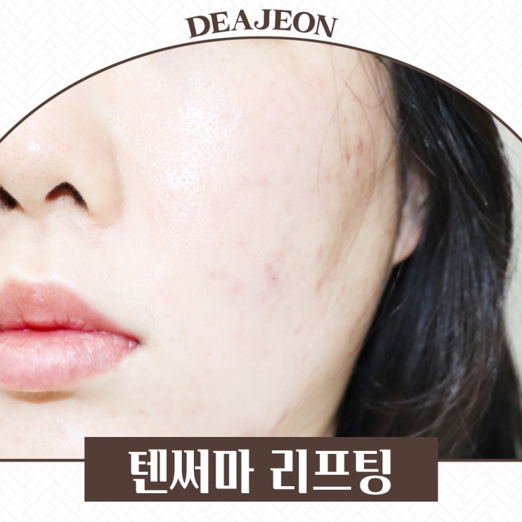  텐써마리프팅 직접 효과 통증 정리했어요 대전리프팅
