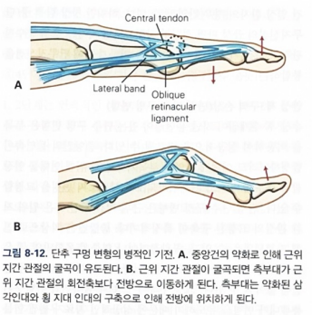 [정형외과 전문의] 신전건 파열, Extensor tendon injury (수부외과) : 네이버 블로그