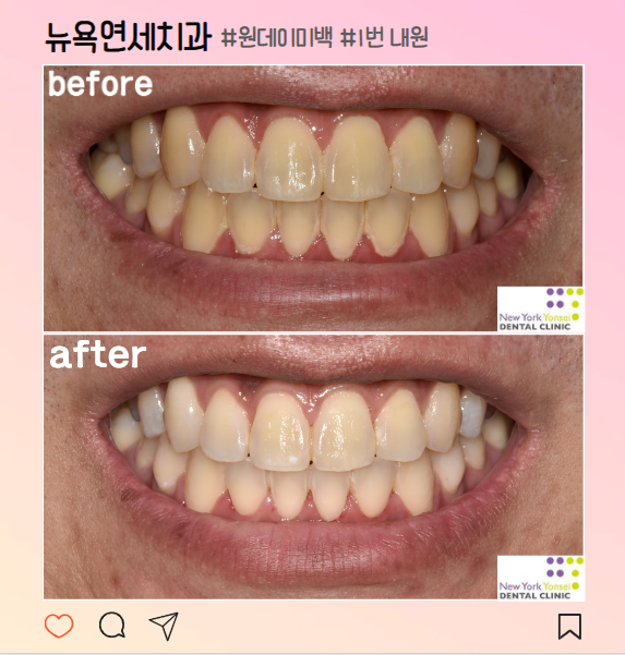  강남역 치아미백/ 부작용 없는 미백치료로 환하게 웃자