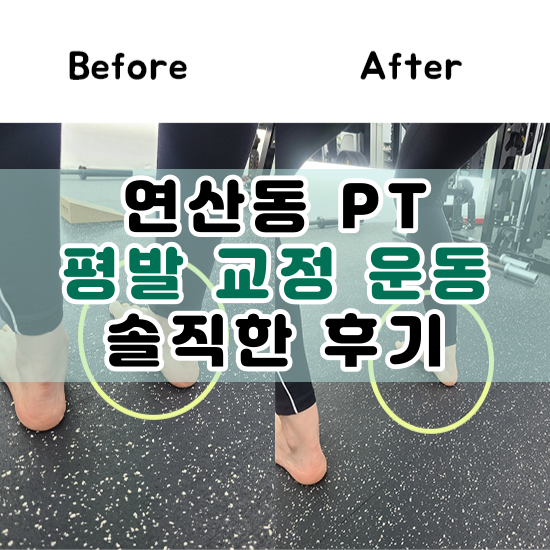  연산동 PT 평발 교정 운동 후기(편평발)