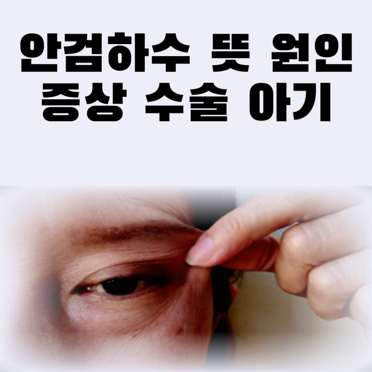  안검하수 뜻 원인 증상 수술 아기