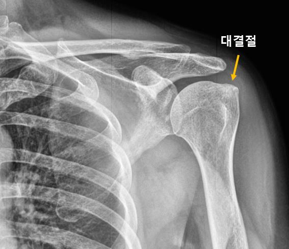  광주오십견, 재발한 이유는 무엇일까요?
