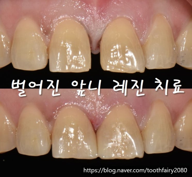 [치간 이개 레진] 앞니 사이 공간(Diastema), 치아삭제 없이 치료하려면