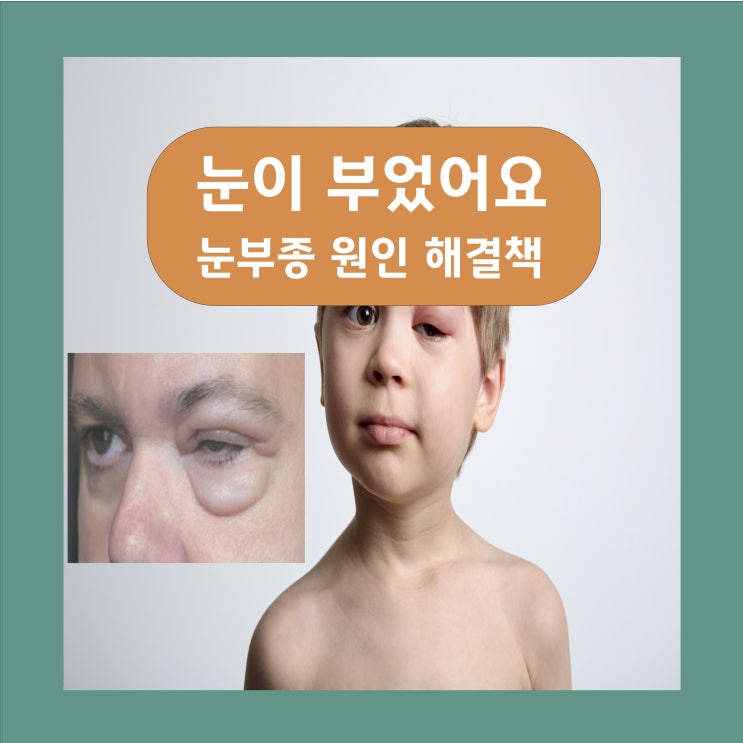  눈부종 눈이 부었어요 원인과 해결책