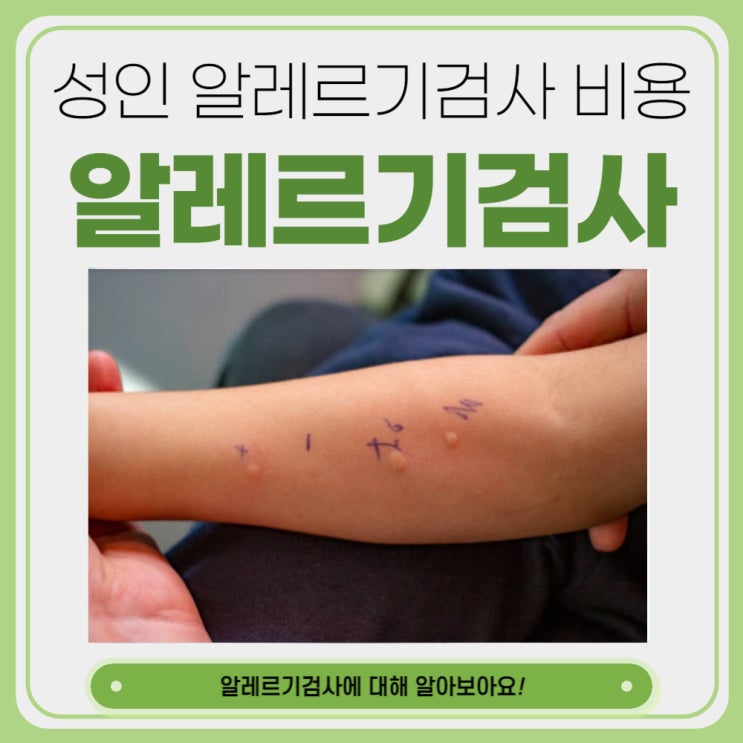  성인알레르기검사 비용 방법 알아보아요.
