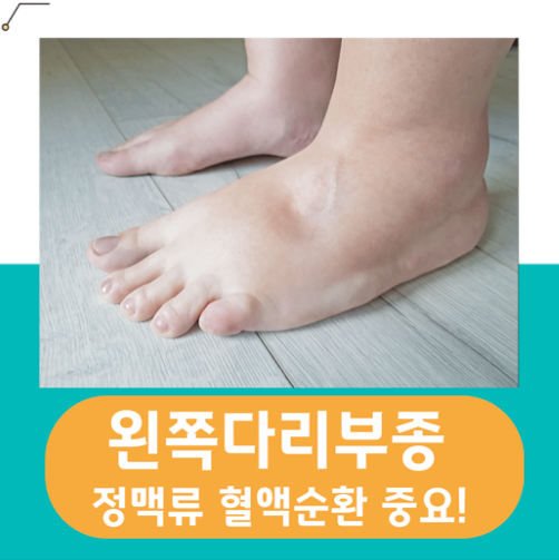  왼쪽다리부종 혈액순환이 중요합니다!