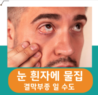  눈 흰자 물집 결막 부종일 수도 있다!
