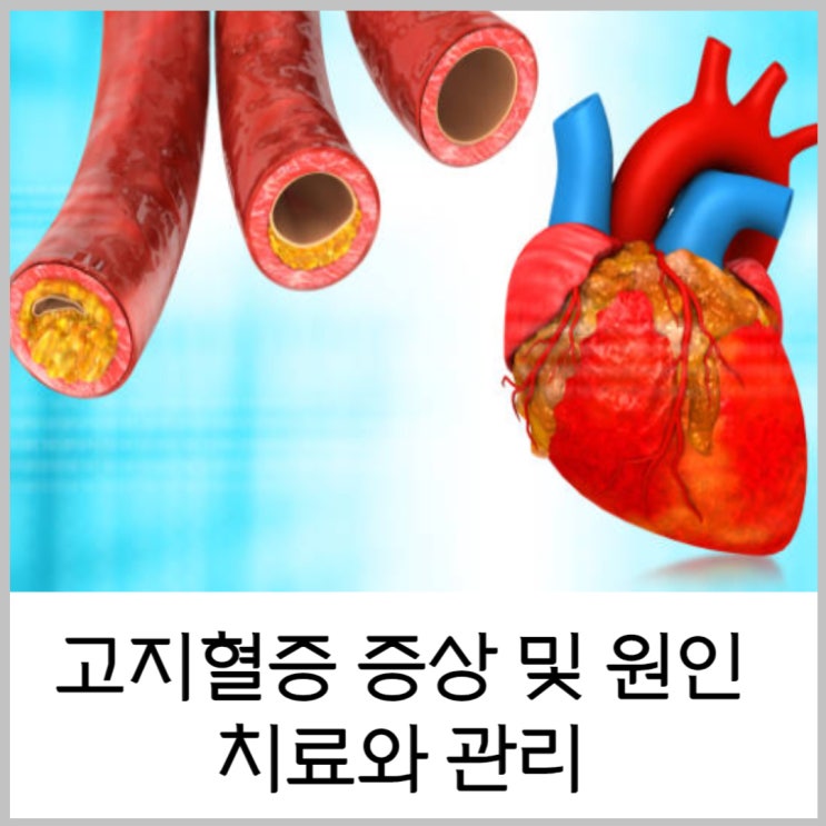  고지혈증 증상 및 원인 치료와 관리