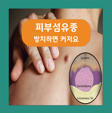  피부섬유종 치료 방치하면 커저요!
