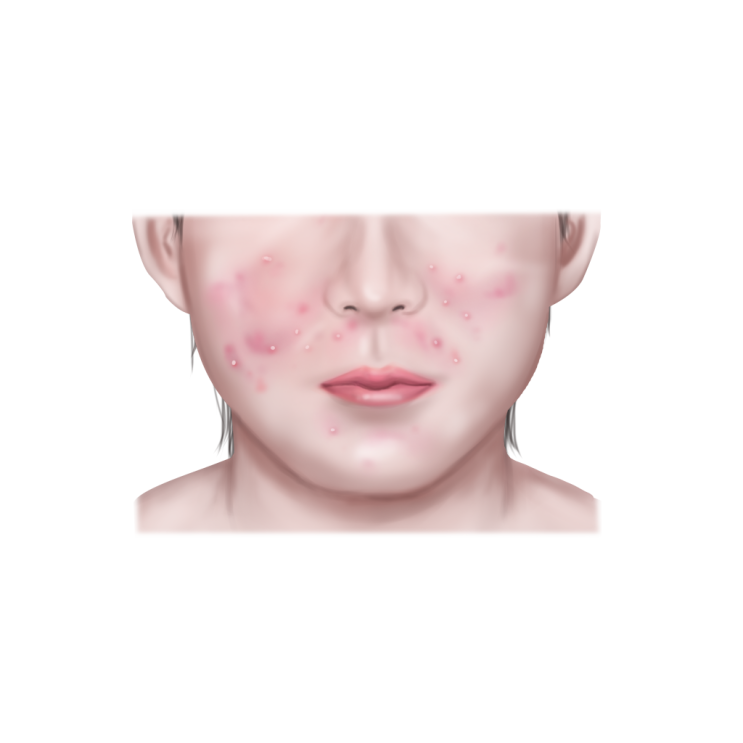  구진성 여드름 원인과 관리 A to Z