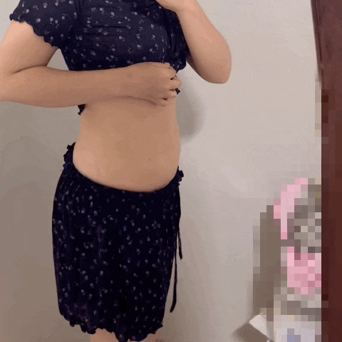  성수피부과 비만클리닉 복부 울핏+엔코어리프팅+고주파 후기 가격, 일주일차 효과