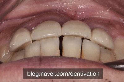 아래 치아만 부분교정 할 수 있나요? 앞니 벌어진 치아 부분교정 - 치아 틈새 없애기