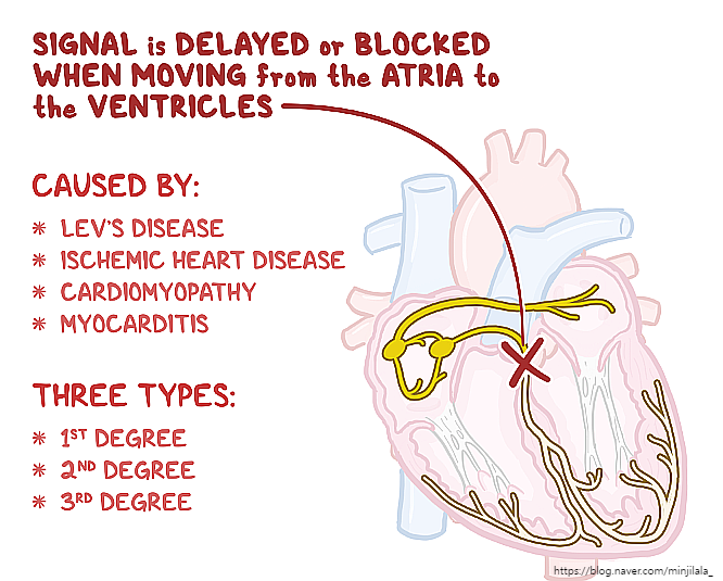  av block atrioventricular block complete block