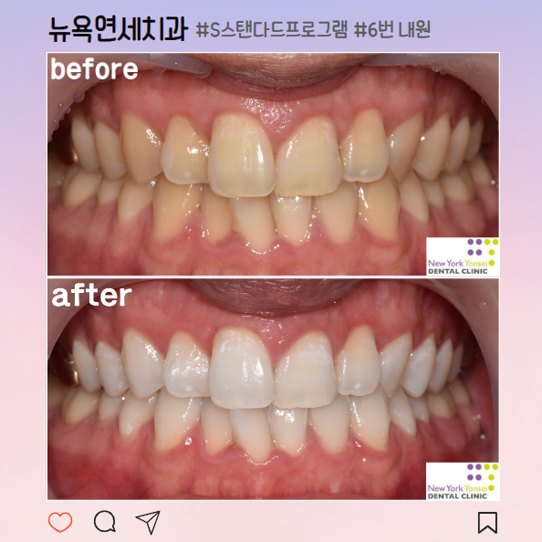  [강남역치과] 결혼식 전 필수/안전하고 효과 좋은 치아미백으로 누런이 해결!