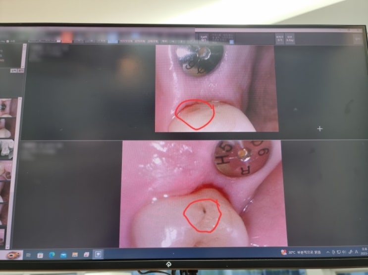 뼈이식 후 3개월. 발치한 치아 인접한 양쪽치아에 충치가? 임플란트 본 뜨러 갔다 충치치료만 하고 온 후기 뼈이식 후 3개월. 발치한 치아 인접한 양쪽치아에 충치가? 임플란트 본 뜨러 갔다 충치치료만 하고 온 후기