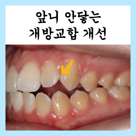  앞니 안닿는 개방교합 교정으로 개선 증례