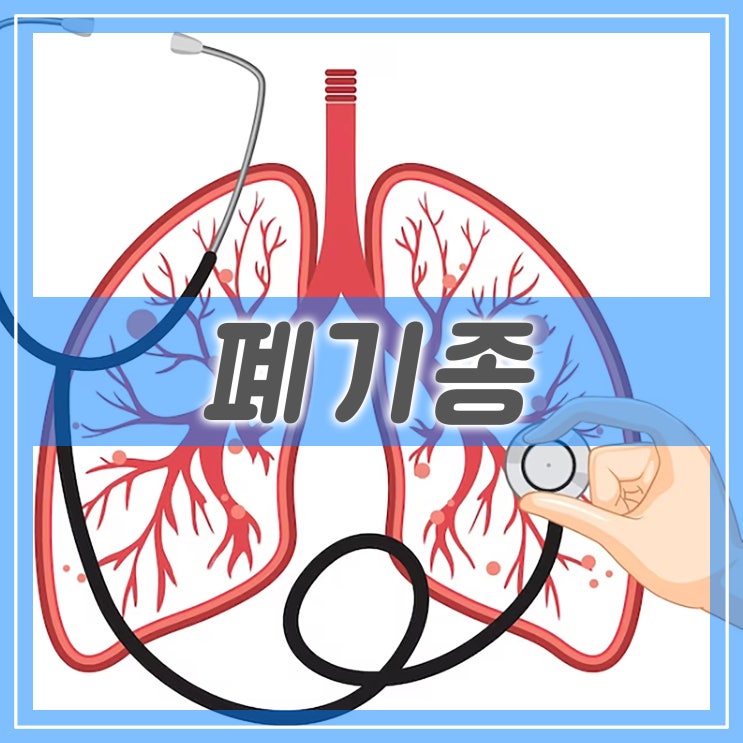  폐의 기낭이 손상되고 늘어난 증상 폐기종 원인과 증상, 치료 방법 폐기종 기본정보