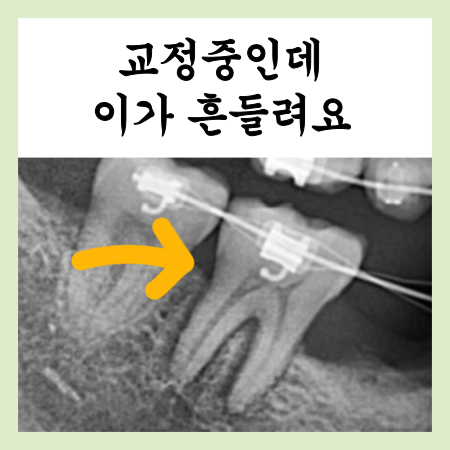  교정중인데 이가 흔들려요