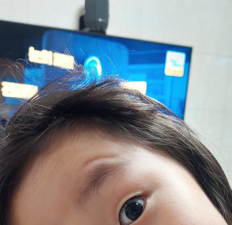  부산 수의원 수 성형외과 봉합수술 과정, 비용, 7개월 후