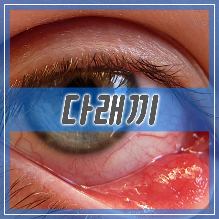  다래끼 (맥립종): 원인, 증상, 치료법
