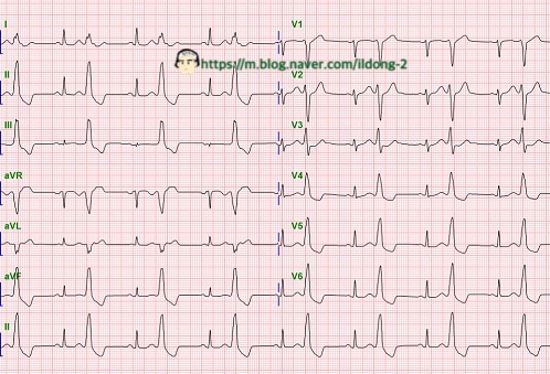  심실조기수축 (이단맥) Ventricular Bigeminy