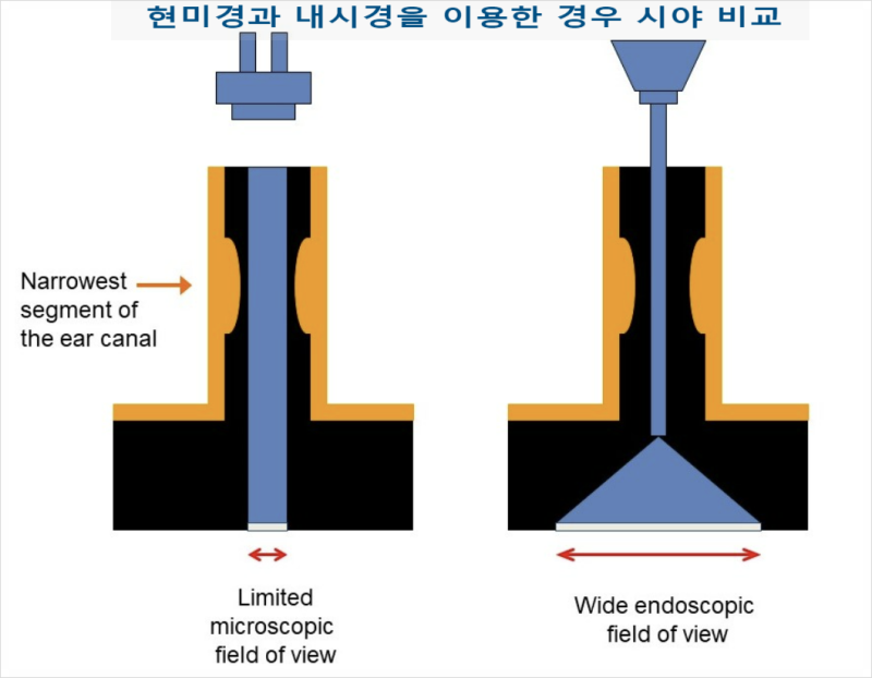 내시경 귀수술(Endoscopic Ear Surgery) 급여 코드 신설 (고시 제2023-153, 161호)