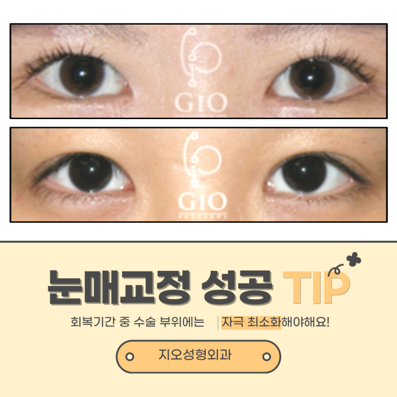 눈매교정 회복기간 및 당김 증상