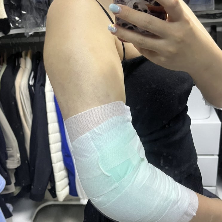  지방추출주사 지팻주사 하고 왔어요!!(겁나아픔)내돈내산