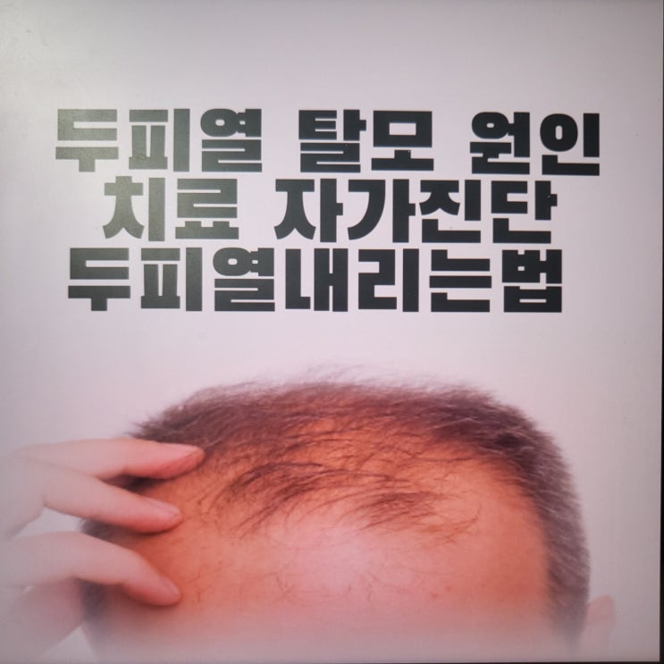  두피열 탈모 원인 치료 두피열내리는법 자가진단