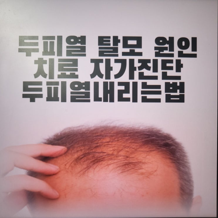 두피열 탈모 원인 치료 두피열내리는법 자가진단