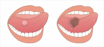 설암 초기증상 및 원인과 치료, 병원, 수술 : 생존율, 사진 : 네이버 블로그